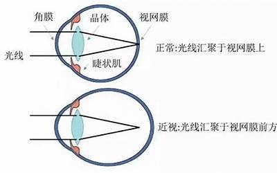 眼睛近视业障(近视眼是什么业障)