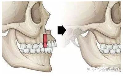下颌前突(下颌前突是什么原因引起的)