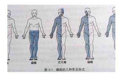 瘫痪的解释(瘫痪是什么意思)